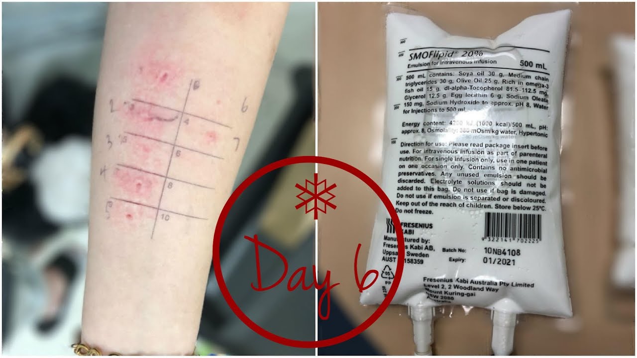 Allergy Skin Prick Testing!! | Vlogmas Day 6 🎄| Amy's Life ♡ - YouTube