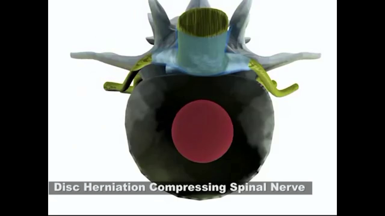 Spinal Decompression