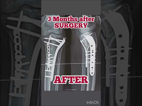 Fracture proximal Tibia