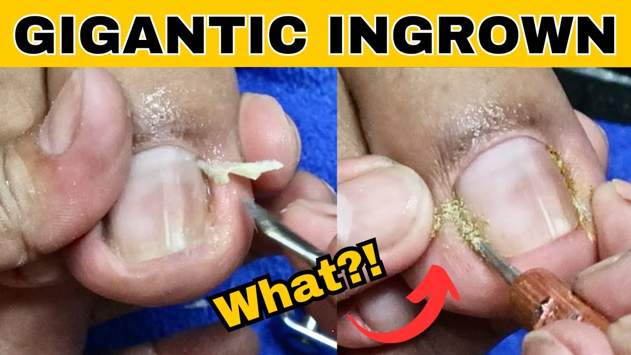 Ingrown Toenail Removal Pedicure YouTube