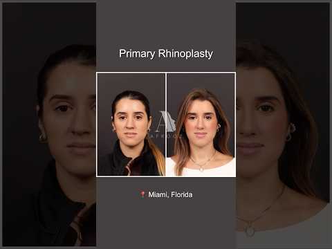 Video thumbnail: 3 Months After Rhinoplasty · Paul N. Afrooz, MD