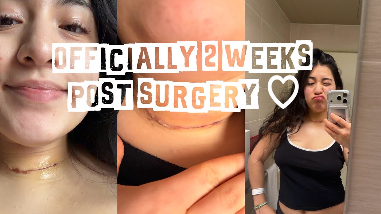 I Didn’t Expect This 2 Weeks After Thyroid Surgery…
