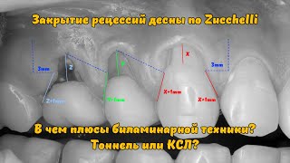 Разбор операции закрытие рецессий десны биламинарной техникой по Zucchelli / gum recession treatment