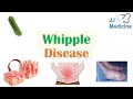 Whipple Disease | Causes, Risk Factors, Pathophysiology, Symptoms, Diagnosis, Treatment