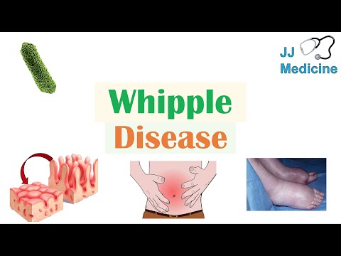 Video: Whipple's Disease - Causes, Stages, Symptoms, Diagnosis, Treatment