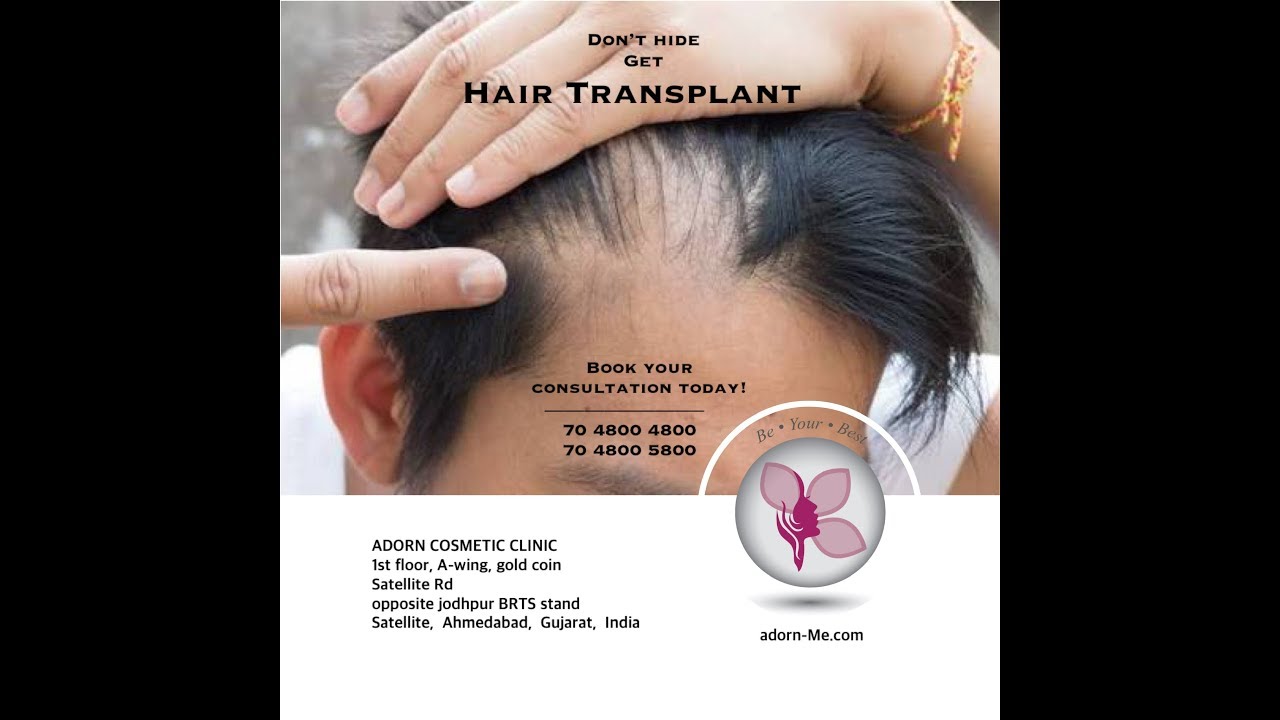 FUE Hair Transplant in Ahmedabad - results of hair Transplant - Hair transplant cost in Gujarat