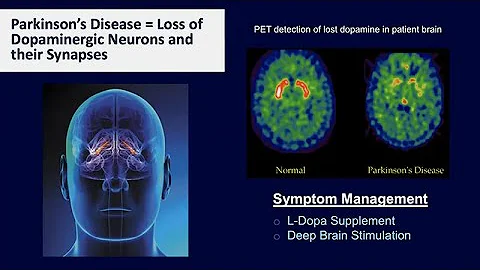 Creating New Neurons: The Potential to Reverse Parkinson’s Disease - DayDayNews