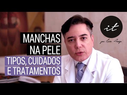 Manchas na Pele -  Tipos, Tratamentos e Cuidados com Manchas de Pele - Melasmas - Dr. Everson Rezeck