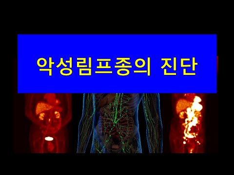 악성림프종의 진단