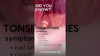 Know about tonsil stones