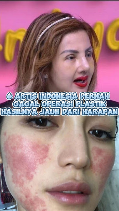 6 Indonesian artists have had failed plastic surgery, the results were far from what they expecte...