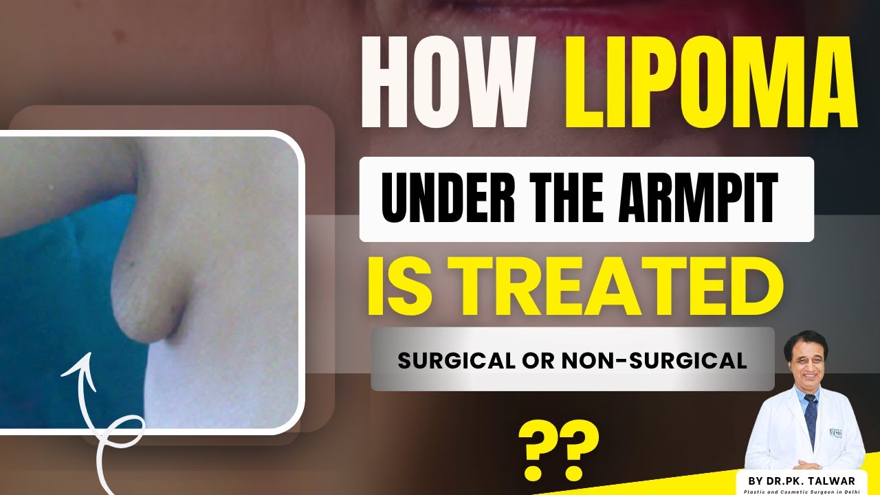 Как лечится липома под мышкой | Хирургические и нехирургические методы лечения | Доктор П. К. Талвар