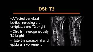 CT and MRI of spine infections