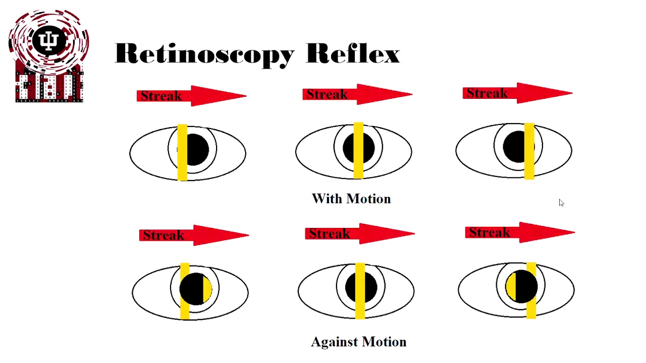 Retinoscopy Reflex Source Youtube