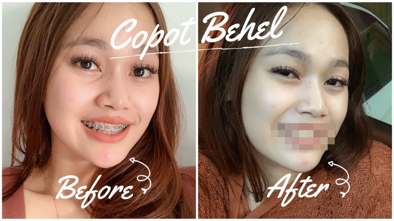 Warna Behel Yang Lagi Trend Mind Books