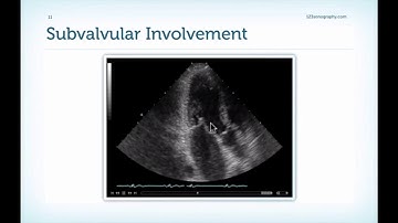 Masterclass lecture 11.4 Mitral stenosis: Valvuloplasty