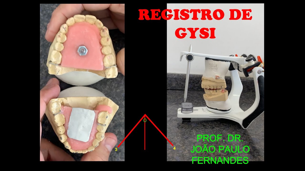 Confecção do Registro de Gysi