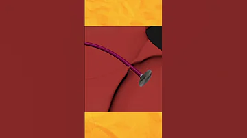 Fixing A Hole In Your Heart PFO Closure Explained 