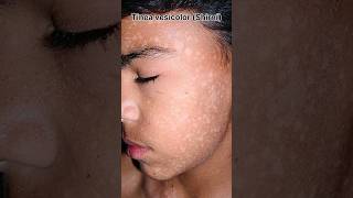 White Spots on the Skin: Vitamin Deficiency or a Disease?