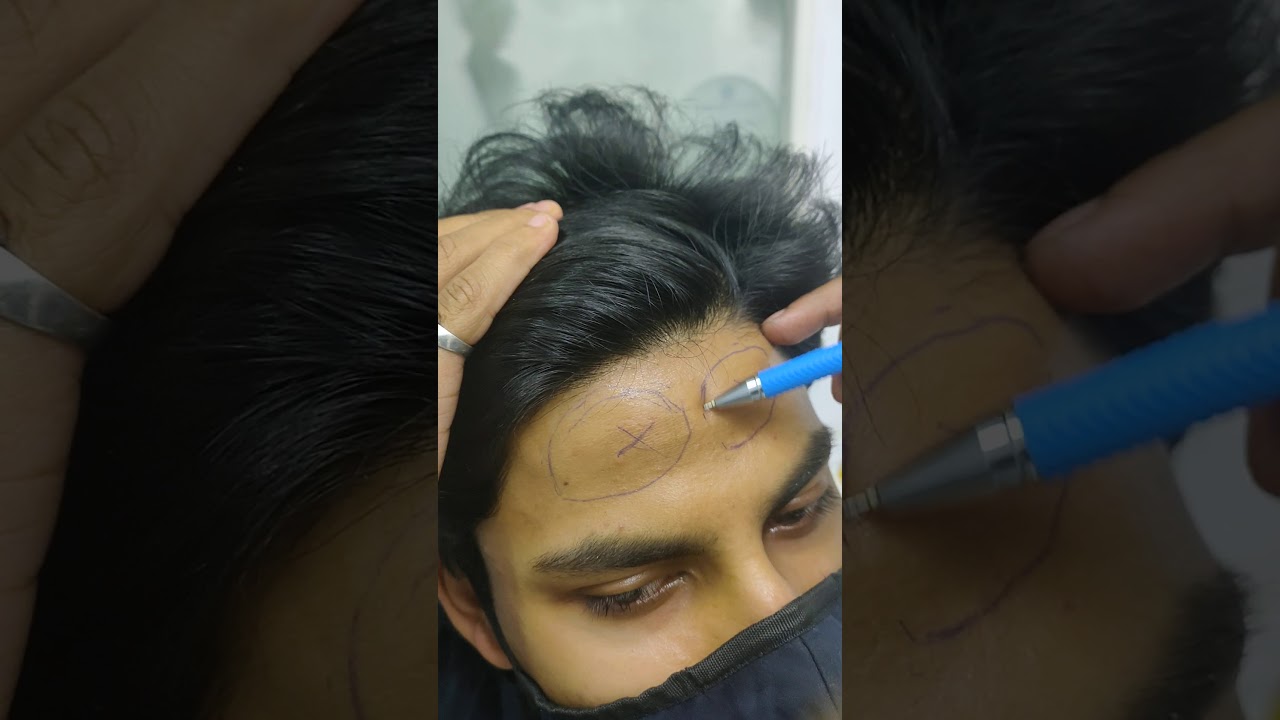 Forehead Bone Reduction Surgery in India-Consultation Dr Pentyala