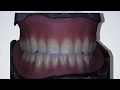 Complete Dentures: Selective Grinding/Bilaterally Balanced Occlusion - Lecture