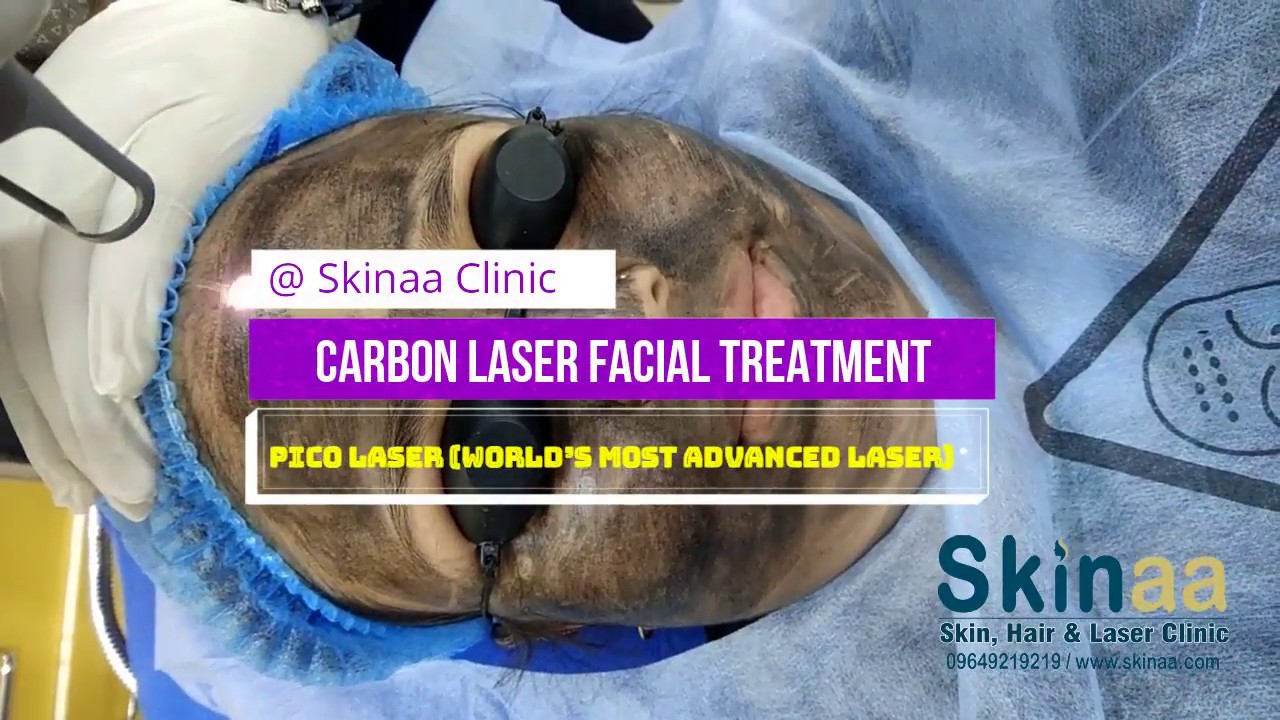 Carbon laser Facial & Peeling Treatment with Pico Laser at Skinaa