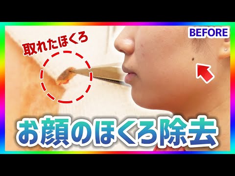 【ほくろ除去】顔のほくろを綺麗に取る方法を美容外科医が解説！施術から術後の経過まで公開します【整形】