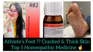 Athlete’s Foot Best Homeopathic Medicine Tinea Pedis Homeopathic Treatments R82 Homeopathic Drop