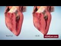 Hypertrophic cardiomyopathy hcm mechanism of disease