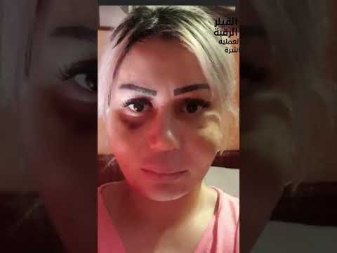 إزاله فيلر دائم وشد الوجه أد ياسر الشيخ فيلر دائم