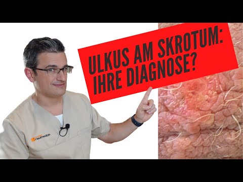 FACHARZTPRÜFUNG DERMATOLOGIE: Geschwür am Skrotum: IHRE DIAGNOSE?