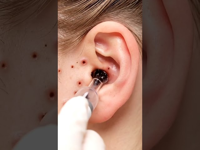 The Most Satisfying Blackhead Extraction Ever!