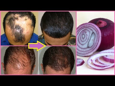 CEBOLA PARA QUEDA DE CABELO ? Conheça Tudo na Cebola e no Crescimento do CABELO