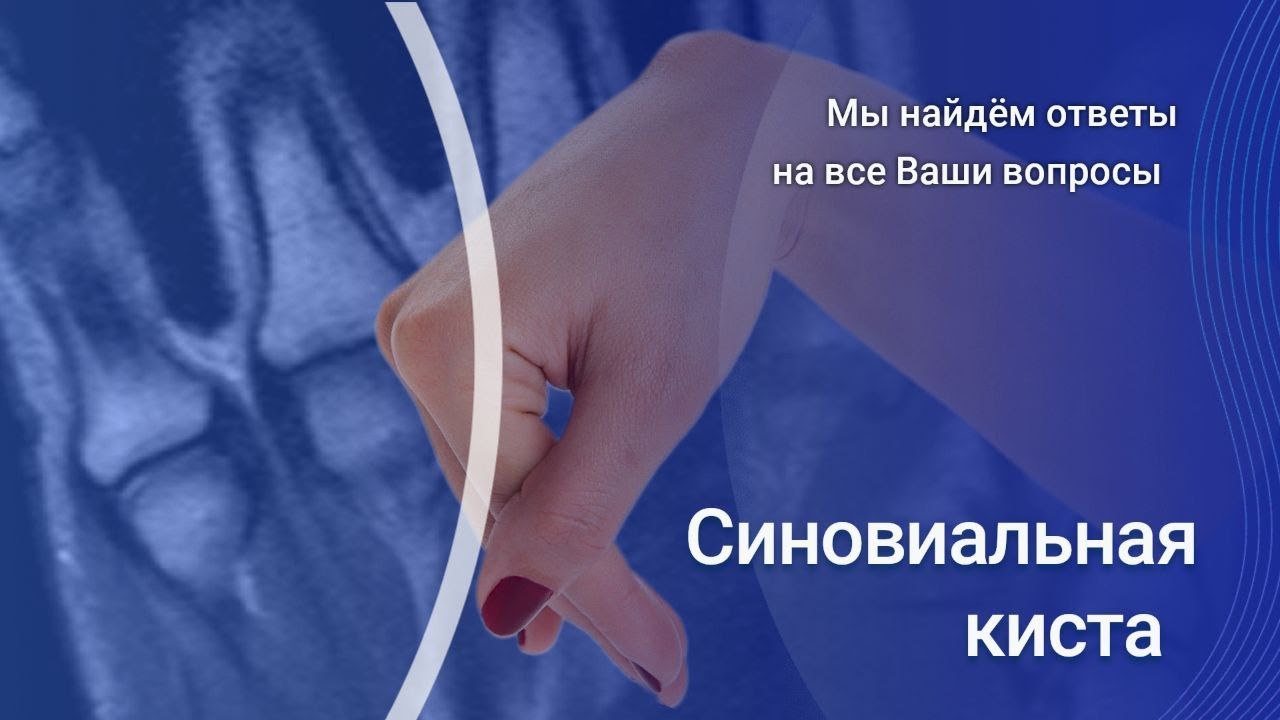Синовиальная киста