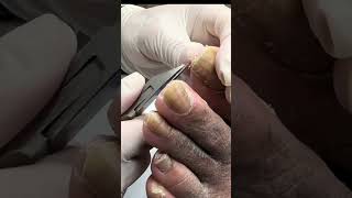 THICK Nail Cutting