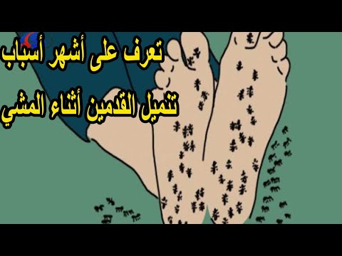 أشهر أسباب تنميل القدمين أثناء المشي