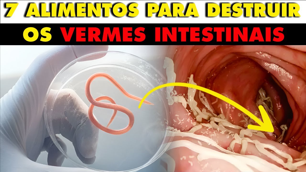 Como Eliminar Vermes Rapidamente: 7 Alimentos Poderosos - YouTube