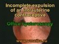 Incomplete expulsion of an intrauterine contraceptive. Hysteroscopy