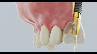 A new path to an abutment screw hole, DIO 2-Channel Abutment