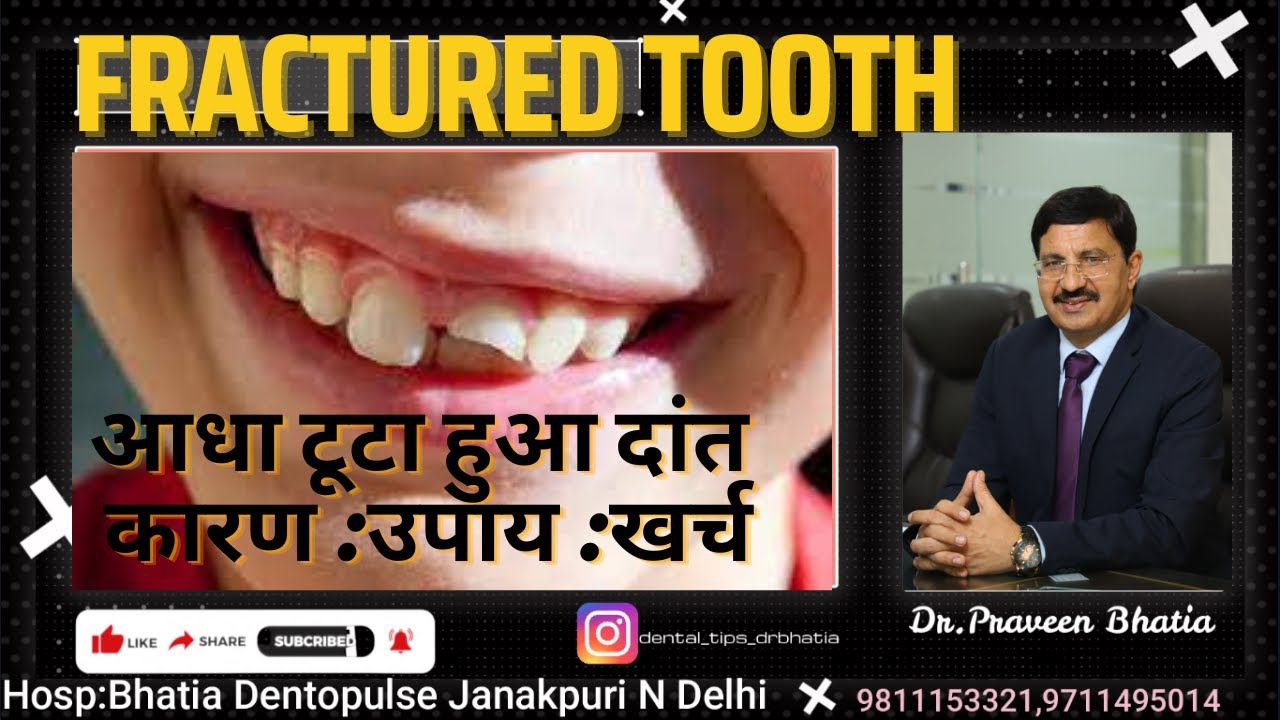 आधा टुटा हुआ दांत -कारण :उपाय :खर्च -HALF BROKEN /FRACTURED tooth MANAGEMENT