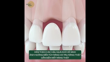 NÊN LÀM CẦU RĂNG SỨ HAY CẤY GHÉP IMPLANT KHI MẤT RĂNG
