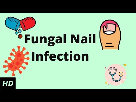 Video: Treatment Of Fungal Nail Infections In Children