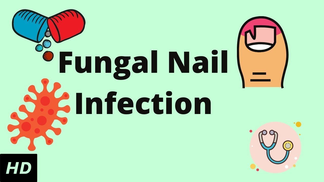 Fungal Nail Infection, Causes, Signs and Symptoms, Diagnosis and ...