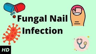 Fungal Nail Infection, Causes, Signs and Symptoms, Diagnosis and Treatment.