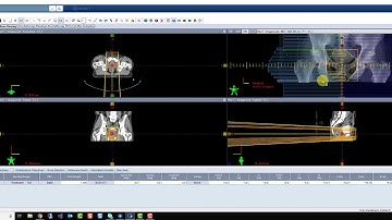 Varian Eclipse APPA Technique