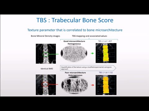 How to use TBS (Trabecular Bone Score) in combination with BMD in Clinical DXA practice.