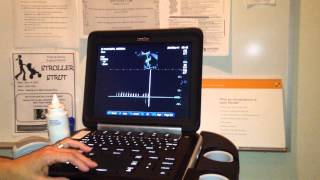 1St Ultrasound Baby Leggs Heartbeat