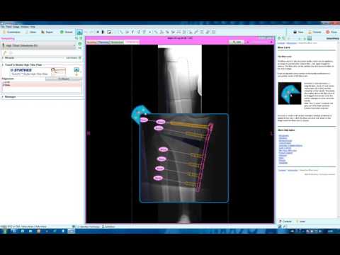 High Tibial Osteotomy (HTO) 2 | Deformity Correction Planning | Materialise OrthoView