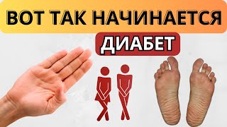 Многие ИГНОРИРУЮТ эти СИМПТОМЫ! Ранние признаки начинающегося сахарного ДИАБЕТА.
