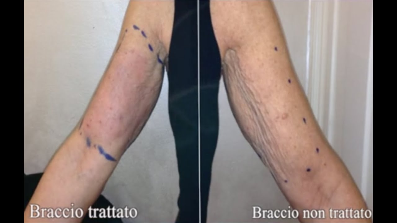 Lifting non chirurgicoEndolift laser BracciaMedicina Estetica